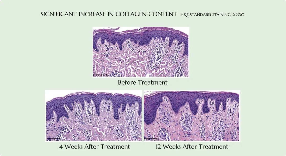 significant increase in collagen content