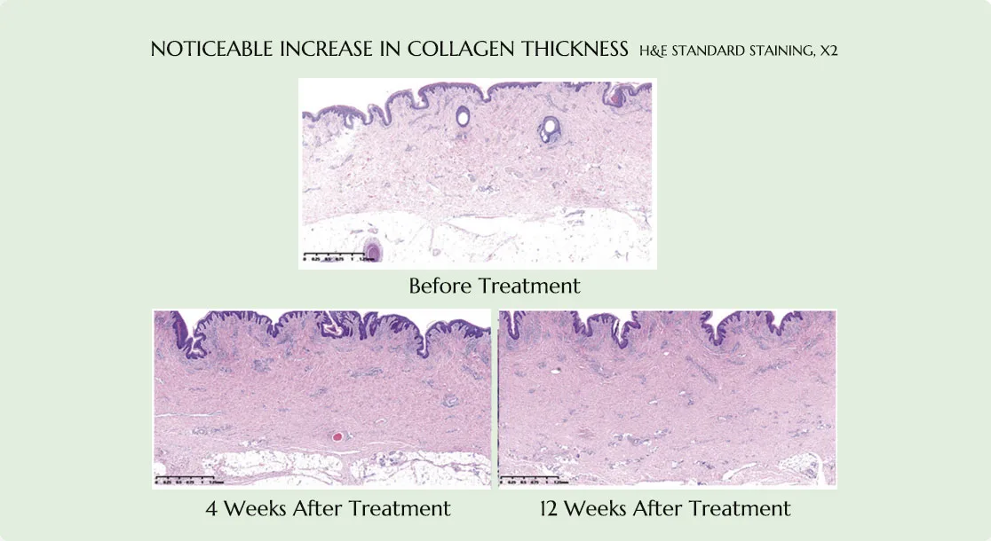 noticeable increase in collagen thickness